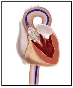 Hjerteklappen indsættes ved hjælp af et kateder.